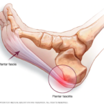 A diagram showing you what this condition is.