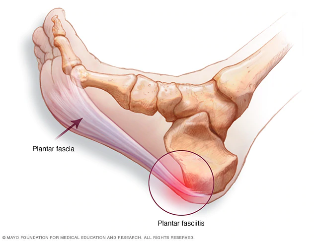 A diagram showing you what this condition is.